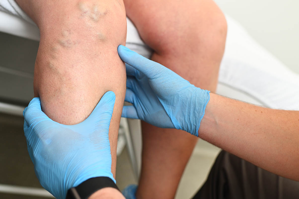 hlebologist examines a patient with varicose veins on his leg.
