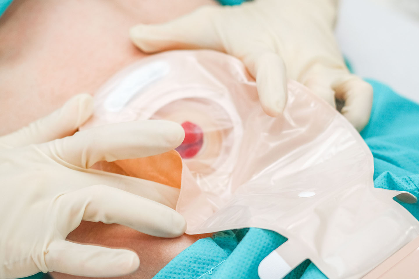 Ostomy2-s